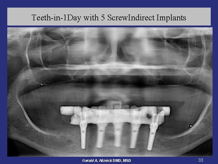 Teeth-in-1 Day with 5 Screw. Indirect Implants Gerald A. Niznick DMD, MSD 33 