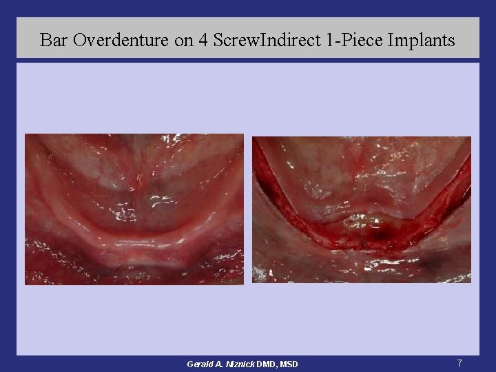 Bar Overdenture on 4 Screw. Indirect 1 -Piece Implants Gerald A. Niznick DMD, MSD