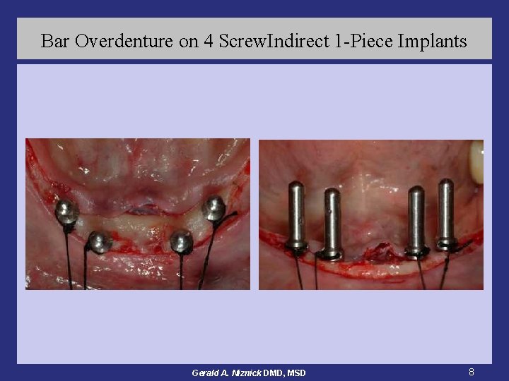 Bar Overdenture on 4 Screw. Indirect 1 -Piece Implants Gerald A. Niznick DMD, MSD