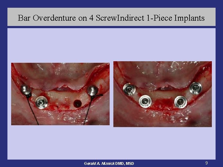 Bar Overdenture on 4 Screw. Indirect 1 -Piece Implants Gerald A. Niznick DMD, MSD