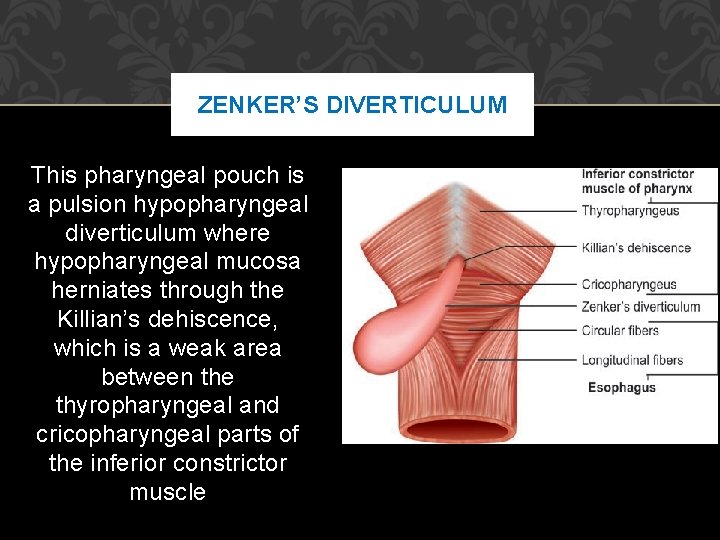 ZENKER’S DIVERTICULUM This pharyngeal pouch is a pulsion hypopharyngeal diverticulum where hypopharyngeal mucosa herniates ZENKER’S DIVERTICULUM This pharyngeal pouch is a pulsion hypopharyngeal diverticulum where hypopharyngeal mucosa herniates