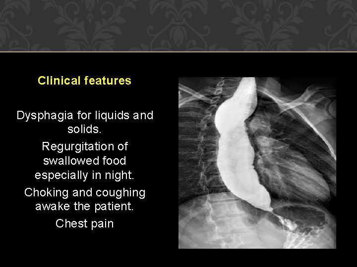 Clinical features Dysphagia for liquids and solids. Regurgitation of swallowed food especially in night. Clinical features Dysphagia for liquids and solids. Regurgitation of swallowed food especially in night.