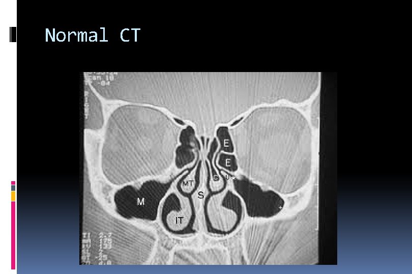 Normal CT 