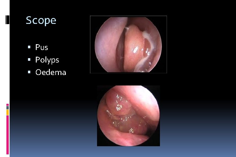 Scope Pus Polyps Oedema 