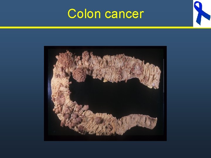 Colon cancer Colon cancer