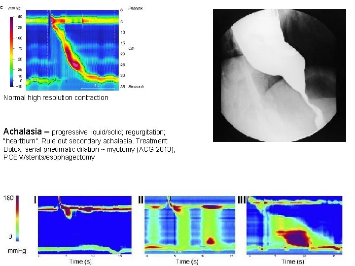 Normal high resolution contraction Achalasia – progressive liquid/solid; regurgitation; “heartburn”. Rule out secondary achalasia.