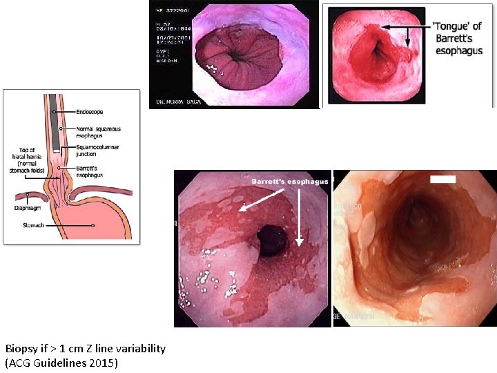 Biopsy if > 1 cm Z line variability (ACG Guidelines 2015) 
