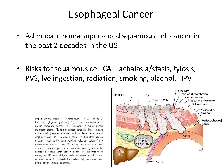 Esophageal Cancer • Adenocarcinoma superseded squamous cell cancer in the past 2 decades in