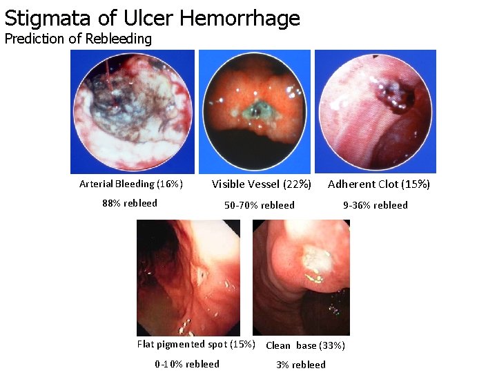 Stigmata of Ulcer Hemorrhage Prediction of Rebleeding Arterial Bleeding (16%) Visible Vessel (22%) 88%