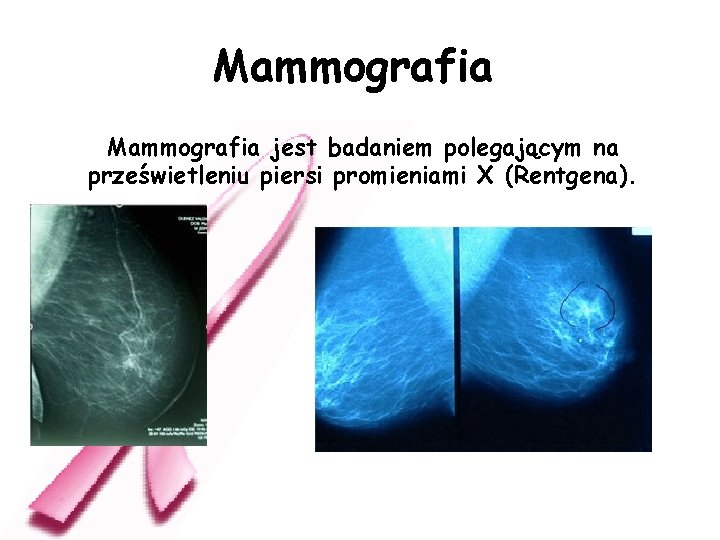 Mammografia jest badaniem polegającym na prześwietleniu piersi promieniami X (Rentgena). 