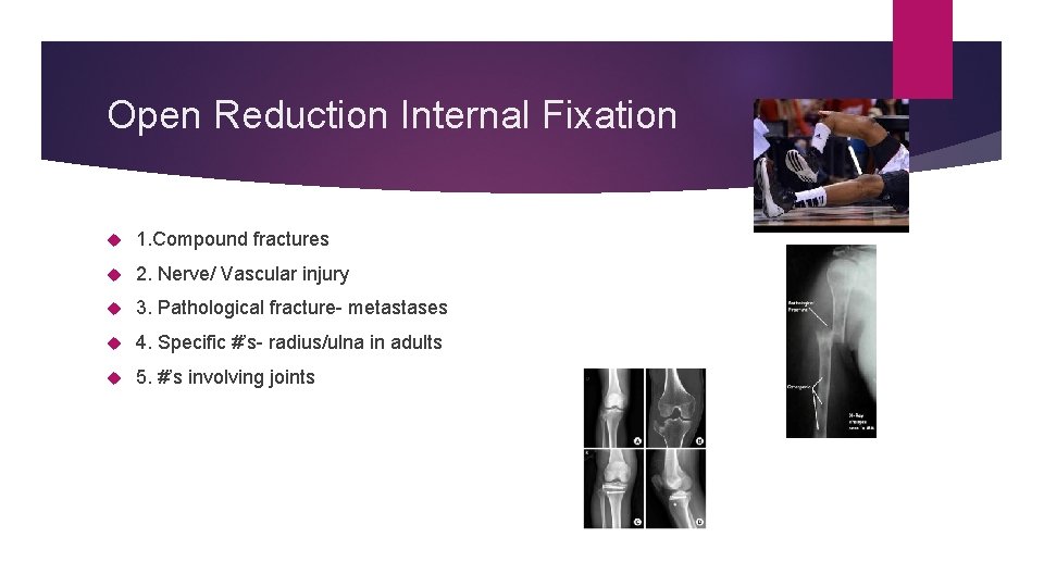 Open Reduction Internal Fixation 1. Compound fractures 2. Nerve/ Vascular injury 3. Pathological fracture-