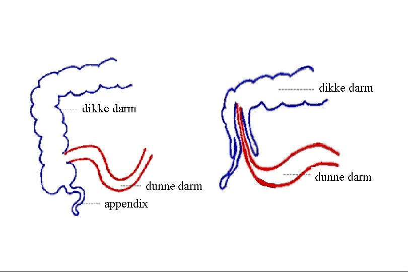 dikke darm dunne darm appendix dunne darm 