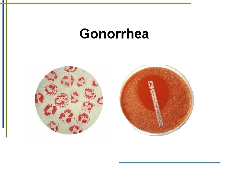 Gonorrhea Gonorrhea