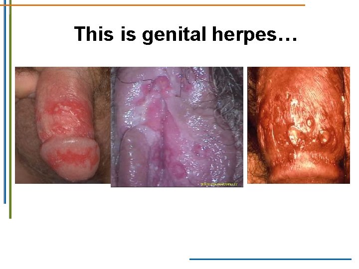 This is genital herpes… This is genital herpes…