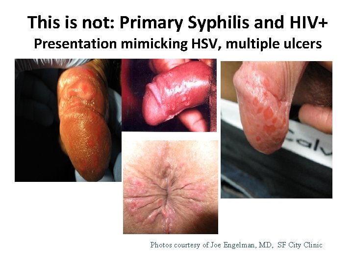 This is not: Primary Syphilis and HIV+ Presentation mimicking HSV, multiple ulcers San Francisco This is not: Primary Syphilis and HIV+ Presentation mimicking HSV, multiple ulcers San Francisco