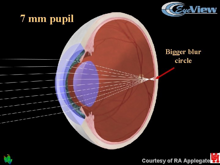7 mm pupil Bigger blur circle Courtesy of RA Applegate 