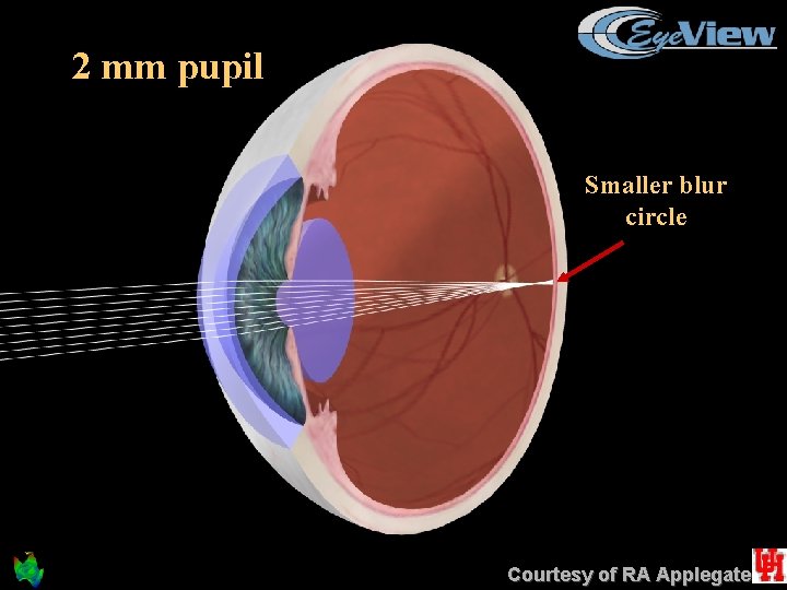 2 mm pupil Smaller blur circle Courtesy of RA Applegate 