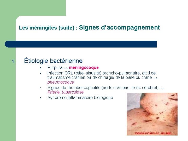 Les méningites (suite) : Signes d’accompagnement 1. Étiologie bactérienne • • Purpura → méningocoque