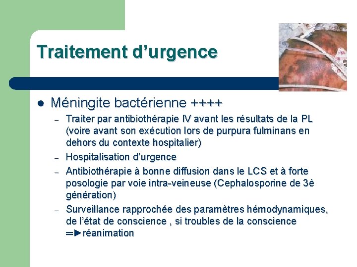Traitement d’urgence l Méningite bactérienne ++++ – – Traiter par antibiothérapie IV avant les