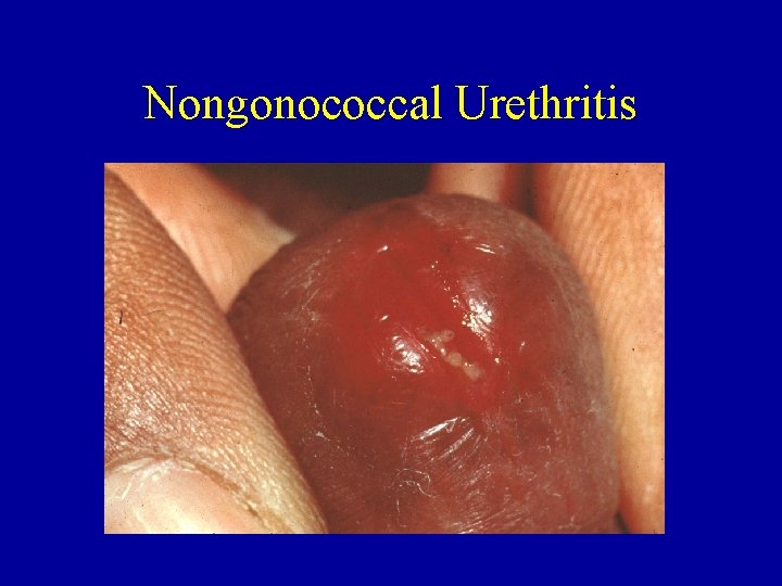 Nongonococcal Urethritis 