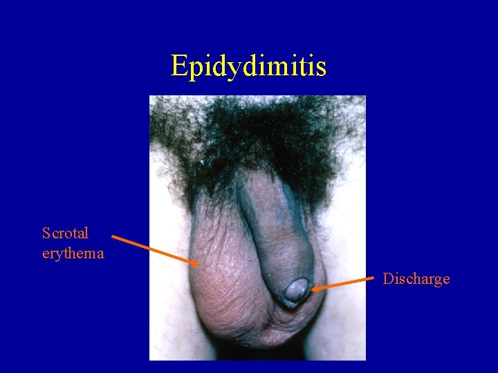 Epidydimitis Scrotal erythema Discharge 