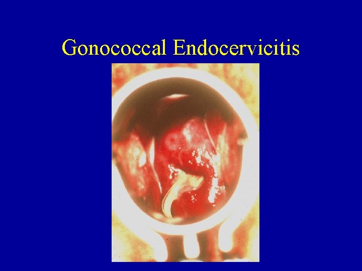 Gonococcal Endocervicitis 