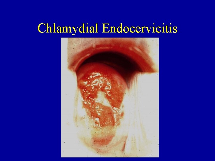 Chlamydial Endocervicitis 