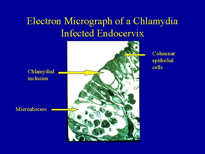 Electron Micrograph of a Chlamydia Infected Endocervix Chlamydial inclusion Microabscess Columnar epithelial cells 