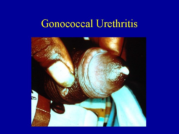 Gonococcal Urethritis 