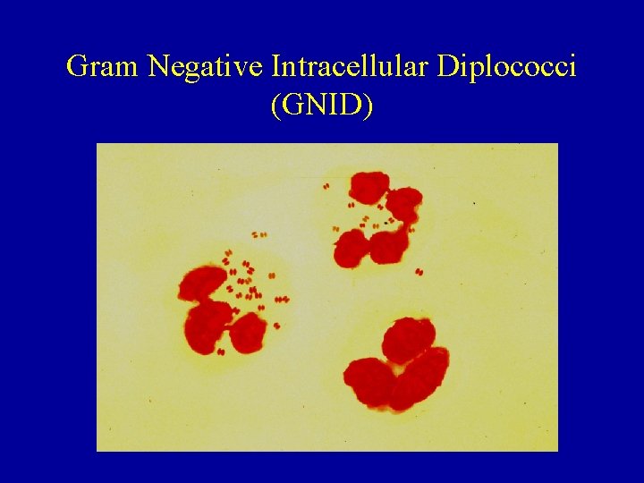Gram Negative Intracellular Diplococci (GNID) 