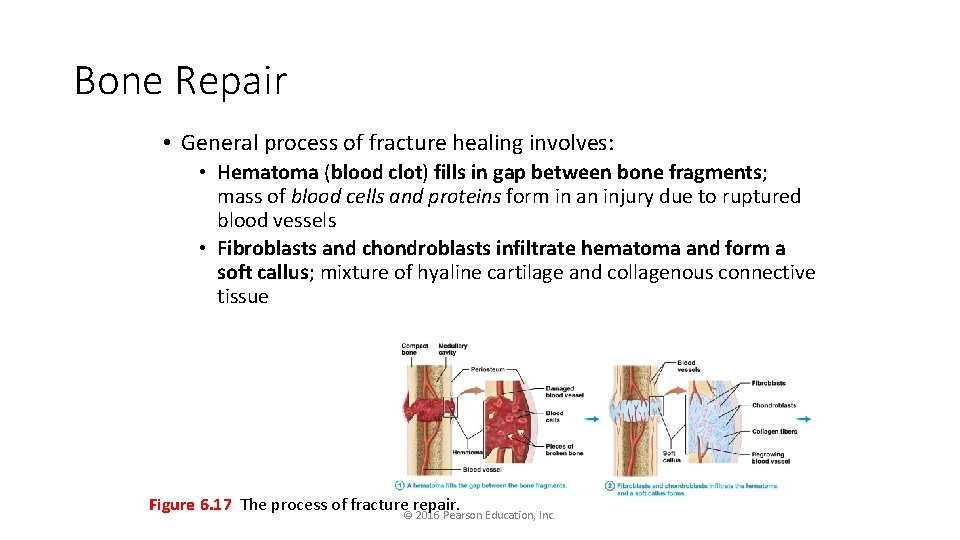 Bone Repair • General process of fracture healing involves: • Hematoma (blood clot) fills