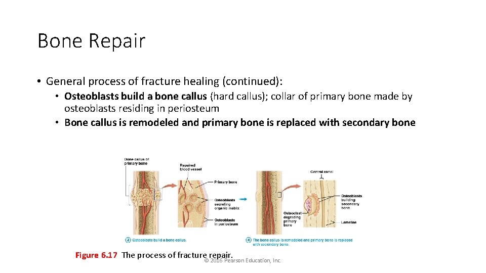 Bone Repair • General process of fracture healing (continued): • Osteoblasts build a bone