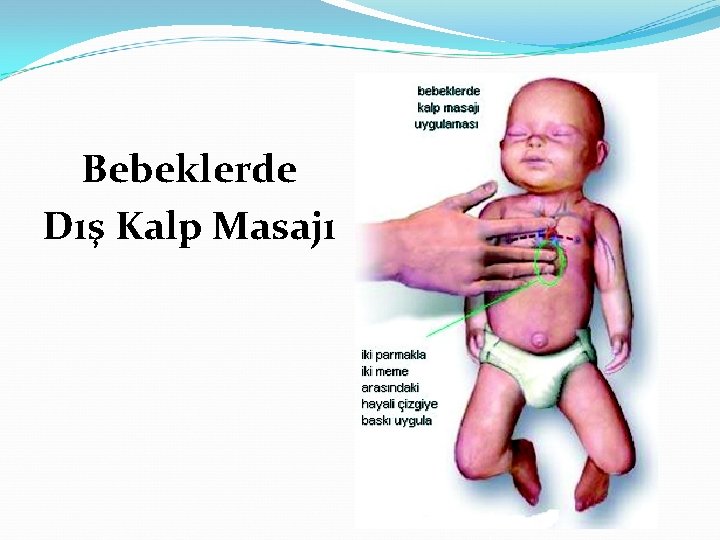 Bebeklerde Dış Kalp Masajı 