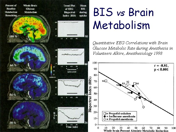 BIS vs Brain Metabolism Quantitative EEG Correlations with Brain Glucose Metabolic Rate during Anesthesia