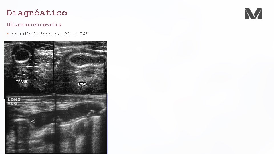 Diagnóstico Ultrassonografia • Sensibilidade de 80 a 94% 