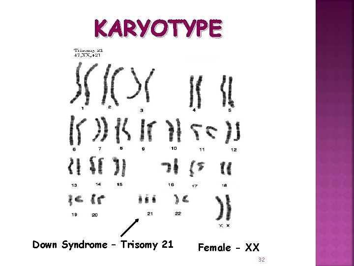 KARYOTYPE Down Syndrome – Trisomy 21 Female - XX 32 