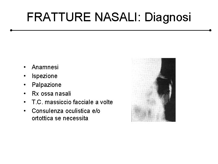 FRATTURE NASALI: Diagnosi • • • Anamnesi Ispezione Palpazione Rx ossa nasali T. C.