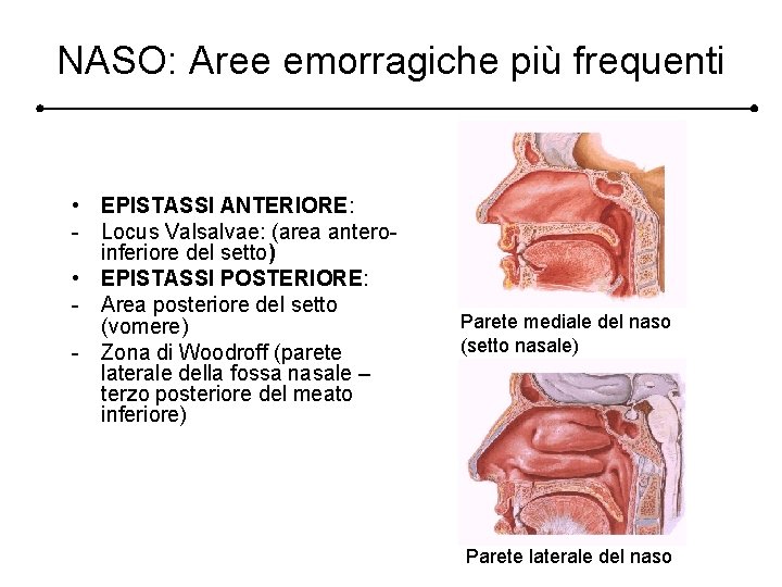 NASO: Aree emorragiche più frequenti • EPISTASSI ANTERIORE: - Locus Valsalvae: (area anteroinferiore del