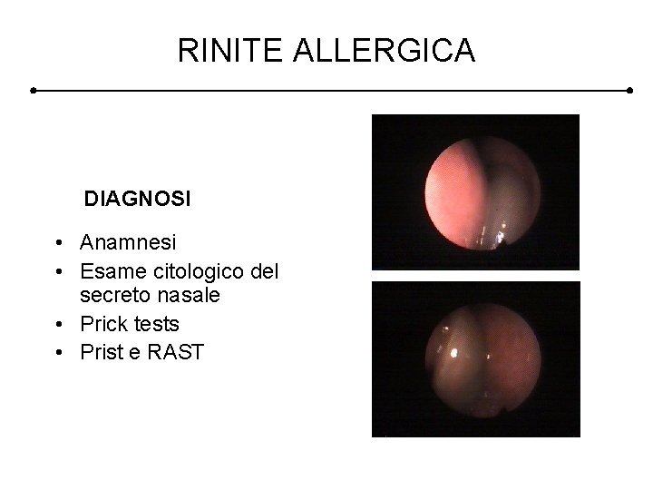 RINITE ALLERGICA DIAGNOSI • Anamnesi • Esame citologico del secreto nasale • Prick tests