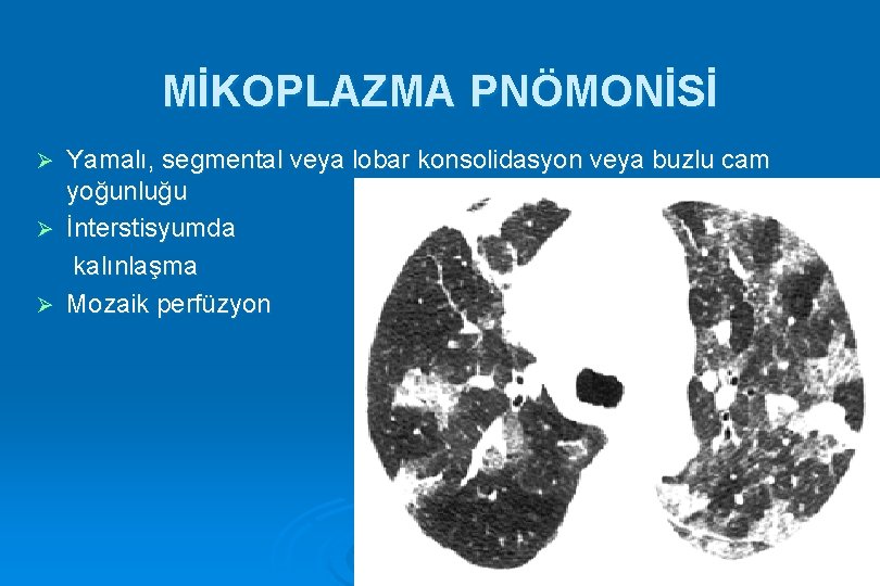 MİKOPLAZMA PNÖMONİSİ Yamalı, segmental veya lobar konsolidasyon veya buzlu cam yoğunluğu Ø İnterstisyumda kalınlaşma