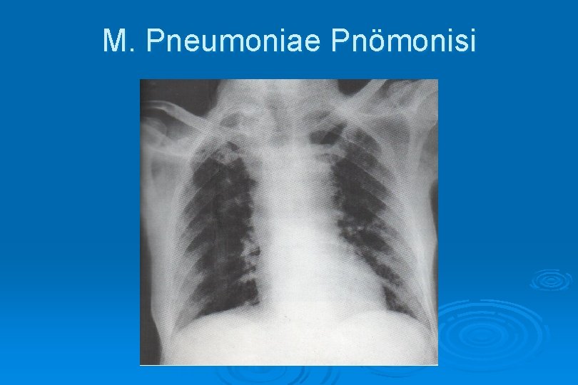 M. Pneumoniae Pnömonisi 