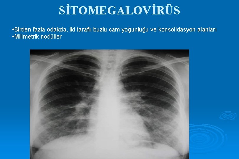 SİTOMEGALOVİRÜS • Birden fazla odakda, iki taraflı buzlu cam yoğunluğu ve konsolidasyon alanları •