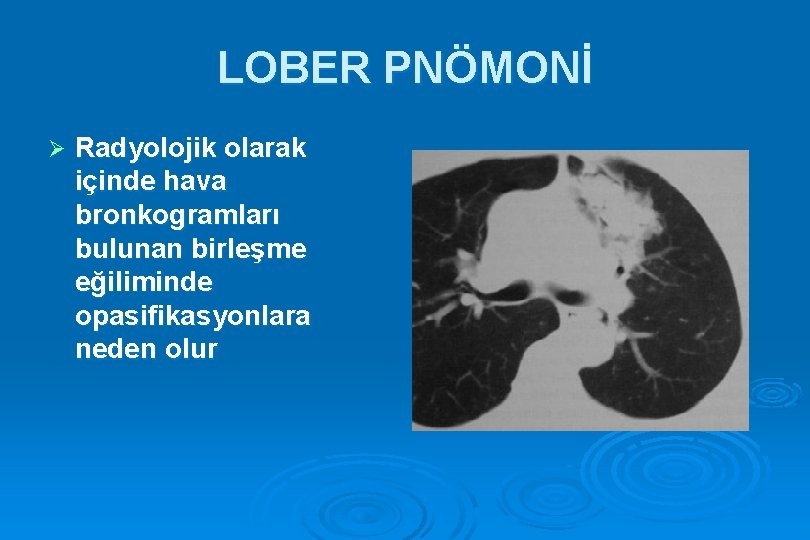 LOBER PNÖMONİ Ø Radyolojik olarak içinde hava bronkogramları bulunan birleşme eğiliminde opasifikasyonlara neden olur