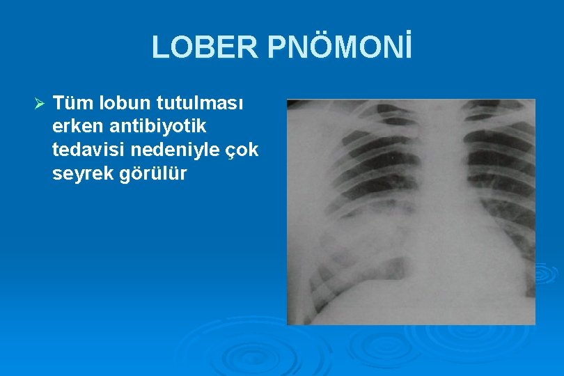 LOBER PNÖMONİ Ø Tüm lobun tutulması erken antibiyotik tedavisi nedeniyle çok seyrek görülür 