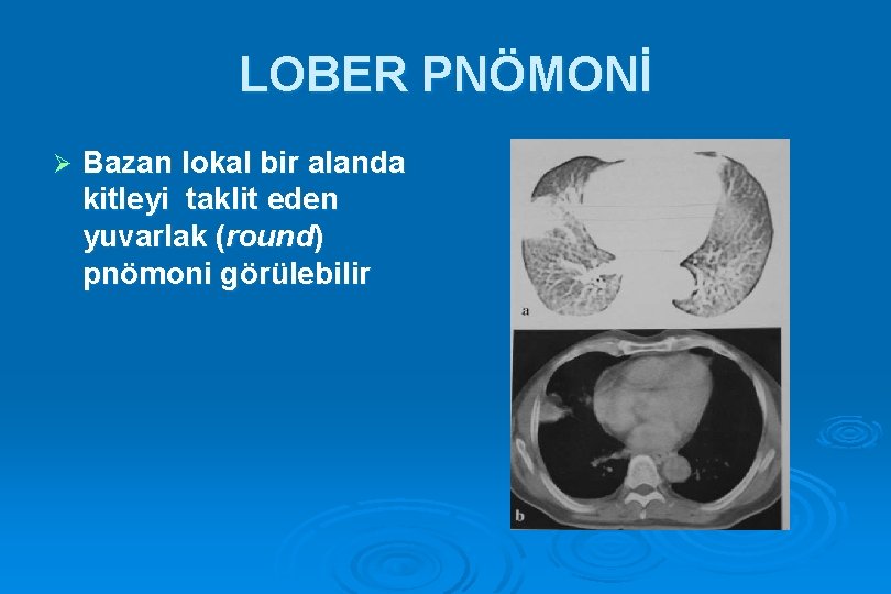 LOBER PNÖMONİ Ø Bazan lokal bir alanda kitleyi taklit eden yuvarlak (round) pnömoni görülebilir