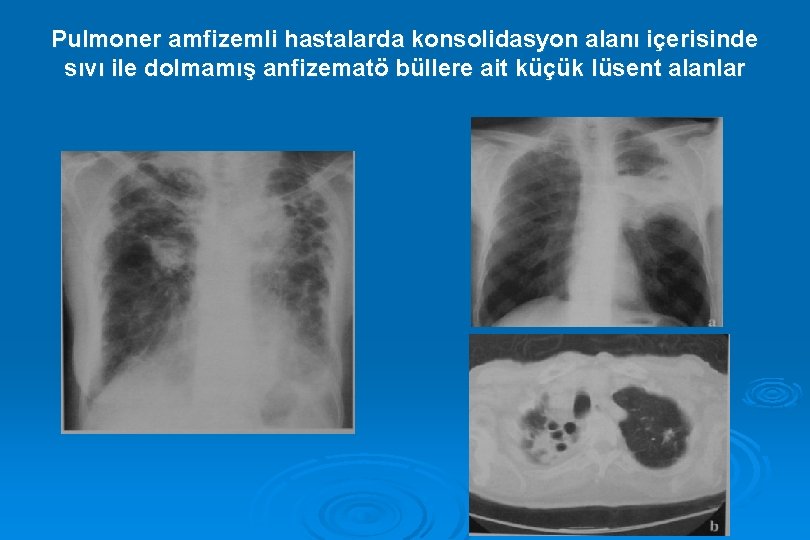 Pulmoner amfizemli hastalarda konsolidasyon alanı içerisinde sıvı ile dolmamış anfizematö büllere ait küçük lüsent