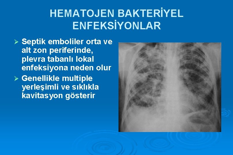 HEMATOJEN BAKTERİYEL ENFEKSİYONLAR Septik emboliler orta ve alt zon periferinde, plevra tabanlı lokal enfeksiyona