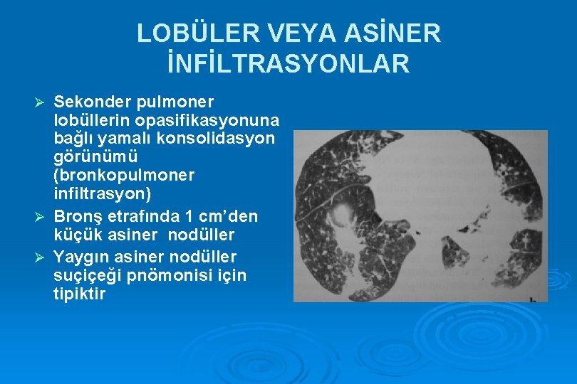 LOBÜLER VEYA ASİNER İNFİLTRASYONLAR Sekonder pulmoner lobüllerin opasifikasyonuna bağlı yamalı konsolidasyon görünümü (bronkopulmoner infiltrasyon)