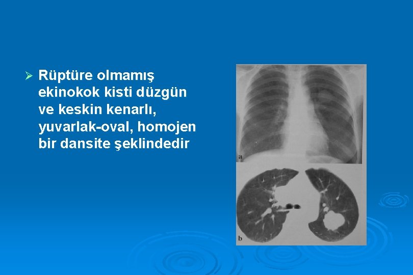 Ø Rüptüre olmamış ekinokok kisti düzgün ve keskin kenarlı, yuvarlak-oval, homojen bir dansite şeklindedir