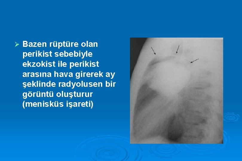 Ø Bazen rüptüre olan perikist sebebiyle ekzokist ile perikist arasına hava girerek ay şeklinde